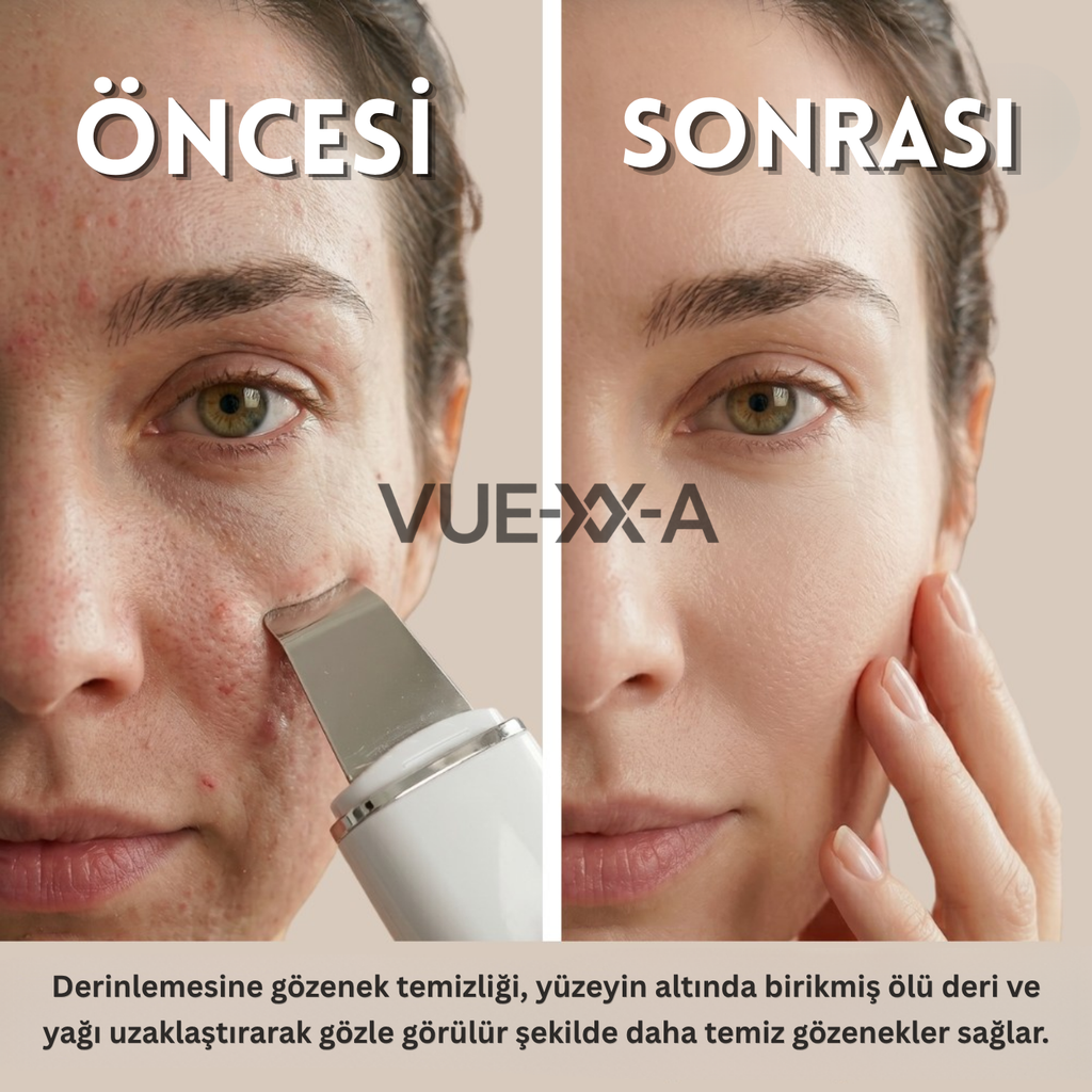 Ultrasonik Spatula Yüz Siyah Nokta Temizleme Aleti